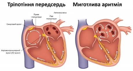 Тріпотіння пересердь і фібриляція передсердь