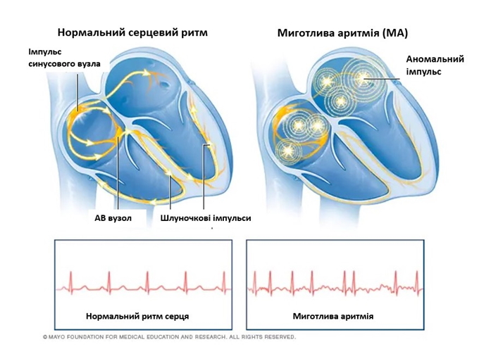 Нормальний серцевий ритм і миготлива аритмія