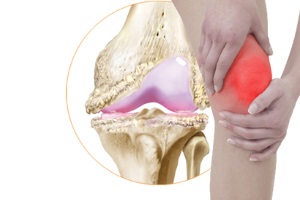 Рекомендации Европейской антиревматической лиги (EULAR) 2003 г.: доказательный подход к лечению пациентов с остеоартрозом коленных суставов