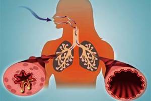 Бронхіальна астма та хронічні обструктивні захворювання легень: сучасний погляд