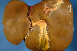 Сучасні аспекти діагностики та лікування хронічного колостазу. Досвід Колопроктологічного центру України