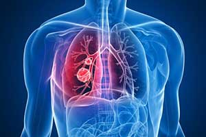 ХОЗЛ и бронхиальная астма: как лечим и как надо лечить