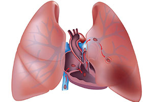 Хроническое легочное сердце: взгляд кардиологов