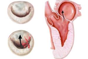 Пролапс мітрального клапана: хвороба чи анатомічна аномалія?