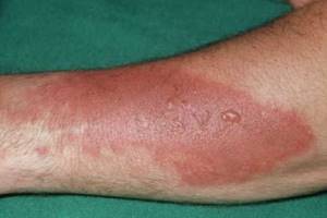 Ожоговая травма