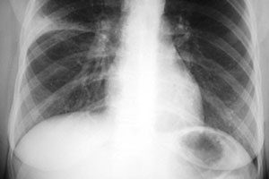 Пневмония сегментарная