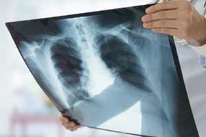 Пневмония затяжная