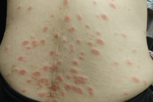 Еритема багатоформна