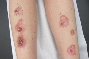 Ліпоїдний некробіоз