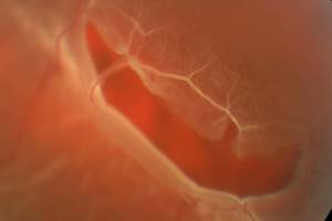 Отслоение и разрыв сетчатки