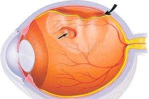 Отслоение сосудистой оболочки