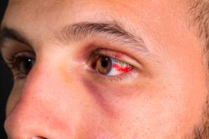 Гематома, отек глазницы