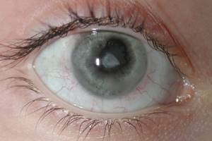 Глаукома вторичная увеальная (вследствие воспаления глаза, глаукомоциклитический криз, гетерохромная увеопатия Фукса, эксфолиативная глаукома, пигментная глаукома)