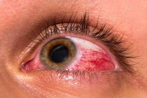 Глаукома вторичная вследствие травмы глаза (гифема, рецессия угла передней камеры, замещение и повреждениехрусталика, факолитическая глаукома)