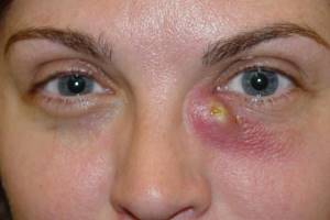 Дакриоцистит острый