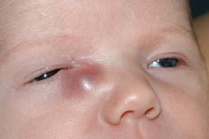 Дакриоцистит хронический