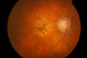 Дегенеративные состояния глаза (аторфия глазного яблока)