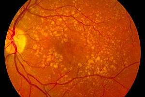 Дегенерация макулы и заднего полюса