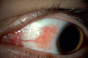 Доброкачественные новообразования роговицы