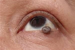 Доброкачественные опухоли глазницы (гемангиома, лимфангиома, гемангиоперицитома, нейрофиброма, менингиома зрительного нерва, дермоидные и эпидермоидные кисты, тератома, глиома зрительного нерва)
