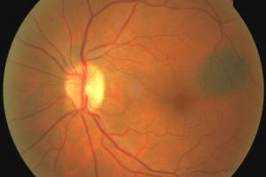 Доброкачественные опухоли сосудистой оболочки