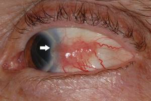 Злокачественные новообразования конъюнктивы