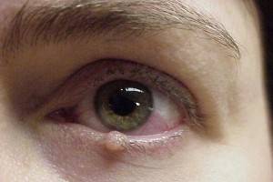 Злокачественные новообразования век