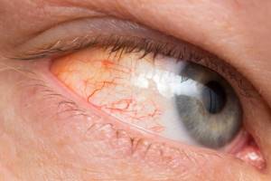 Конъюнктивит хронический