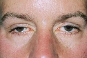 Прогресуюча зовнішня офтальмоплегія (Синдром Кернза-Сайра)