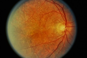 Спадкова дистрофія сітківки (пігментний ретиніт, белоточечний ретиніт, дистрофія Беста, хвороба Штаргардта - жовто-плямиста дистрофія)