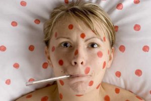 Ветряная оспа: причины, симптомы, диагностика и лечение