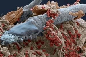 «Кожный» клещ: заболевание или вариант нормы?