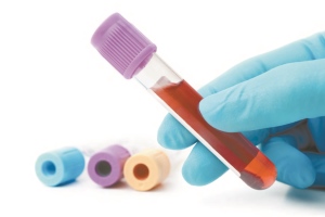 Синдром Жильбера