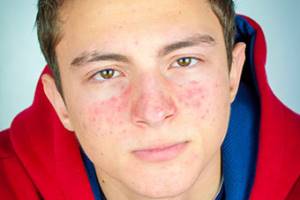 Розацеа: лечение без риска, кожа – без красноты