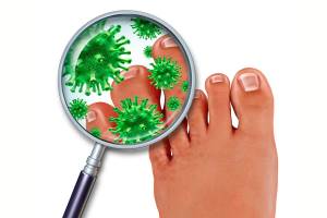 Грибок на ногтях: симптомы и лечение