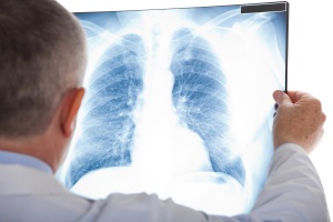 Туберкулез: причины, симптомы и особенности лечения