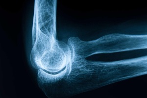 Остеопороз: «тихая» болезнь с грозными последствиями