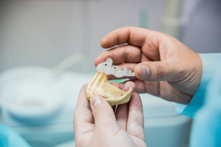 Когда и зачем проводится имплантация зуба?