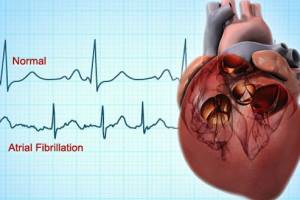 Диагностика и лечение фибрилляции предсердий