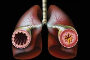 Бронхиальная астма – проблемы и достижения
<br>По материалам 15-го ежегодного конгресса европейского респираторного общества
