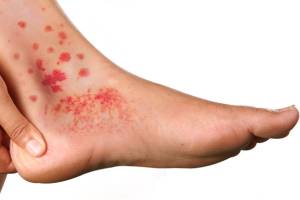 Клінічний протокол надання медичної допомоги хворим на кріоглобулінемію поліклональну есенціальну