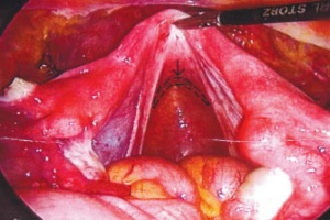 Лапароскопически ассистируемая вагинопластика при аплазиях влагалища