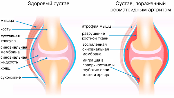 степень активности ревматоидного артрита