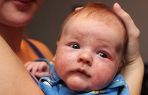 Детская экзема