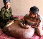 У молодого вьетнамца на ноге выросла опухоль весом в 84 кг