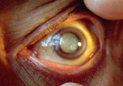 Впервые в истории медицины создан препарат для лечения катаракты