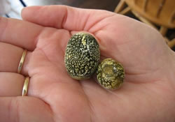 Камни из желчного  пузыря удалит «пылесос»