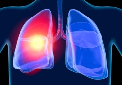 Новый метод диагностики рака: дыхательный тест вместо биопсии