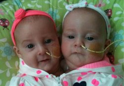 Больше не вместе: хирурги успешно разделили сросшихся близнецов