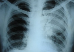 Испытания нового препарата для лечения туберкулеза начнутся в Африке